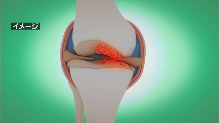 AKS療法 DVD 4枚組+梨状筋筋細胞リリース+AKSセルフ施術 AKS療法